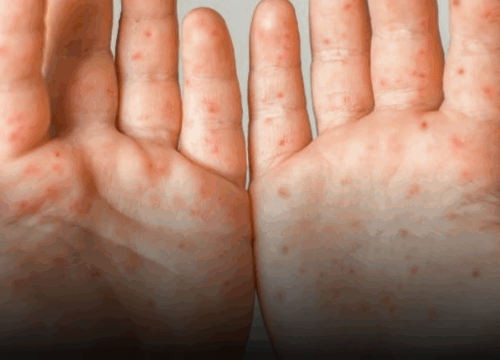 Confirman 10 casos de enfermedad de manos, pies y boca en jardín infantil de Aranzazu, Caldas