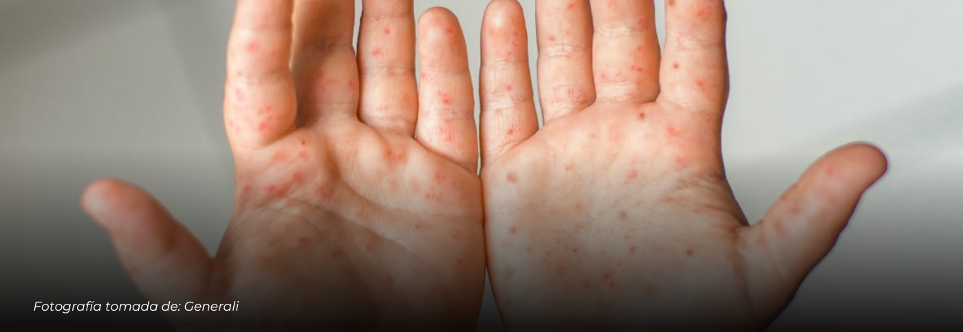 Confirman 10 casos de enfermedad de manos, pies y boca en jardín infantil de Aranzazu, Caldas