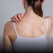 Detectan casos de varicela en universidad de Manizales