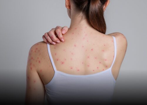 Detectan casos de varicela en universidad de Manizales