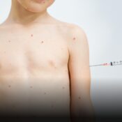 Colombia alerta por casos importados de sarampión y refuerza medidas de prevención