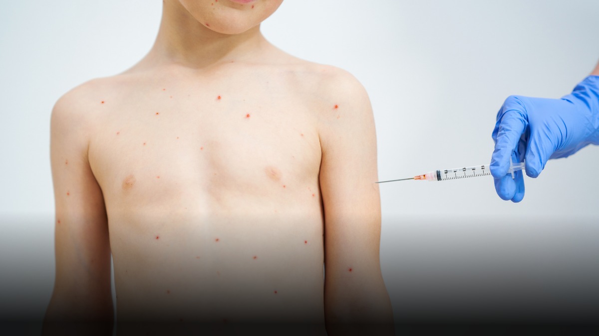 Colombia alerta por casos importados de sarampión y refuerza medidas de prevención