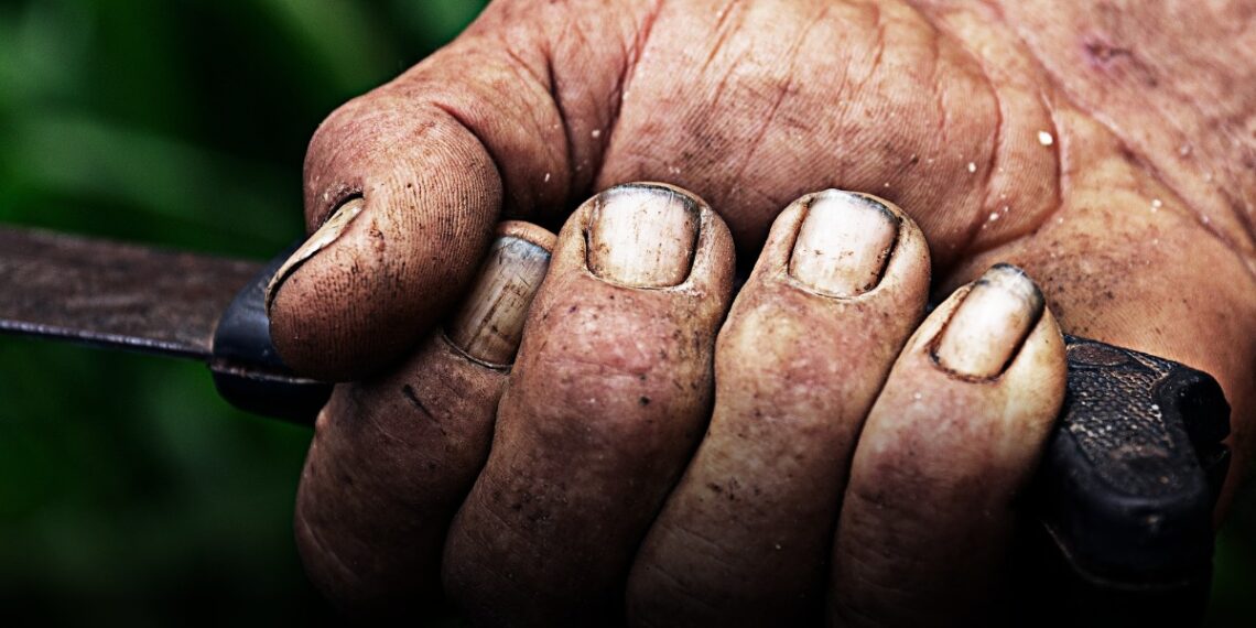 Capturan a hombre de Caldas por brutal ataque a su pareja en Huila; la víctima perdió una mano Capturan a hombre de Caldas por brutal ataque a su pareja en Huila; la víctima perdió una mano