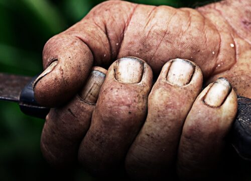 Capturan a hombre de Caldas por brutal ataque a su pareja en Huila; la víctima perdió una mano Capturan a hombre de Caldas por brutal ataque a su pareja en Huila; la víctima perdió una mano